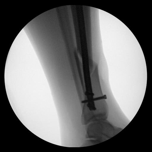 Darn ankle