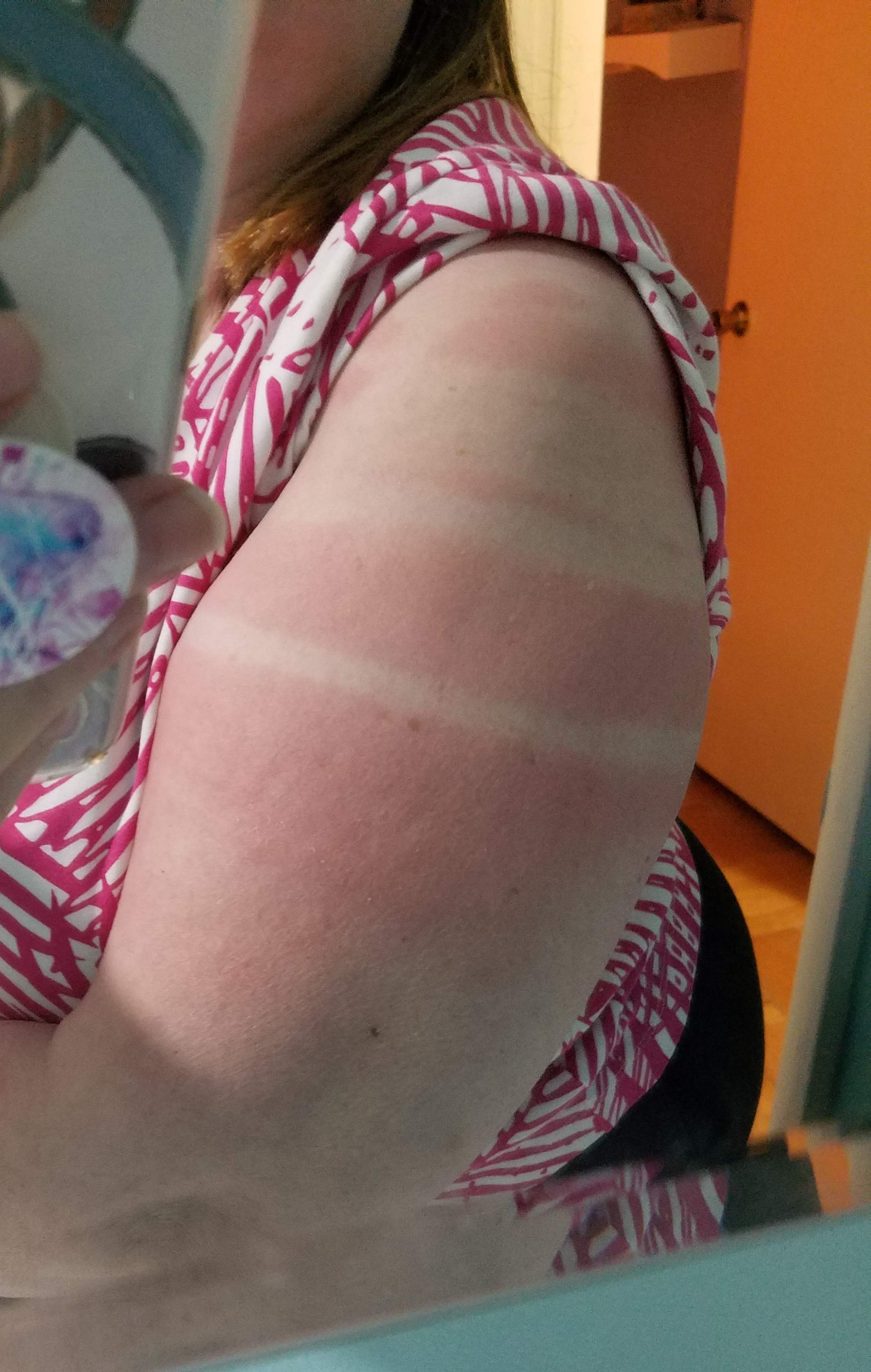 Sunburn