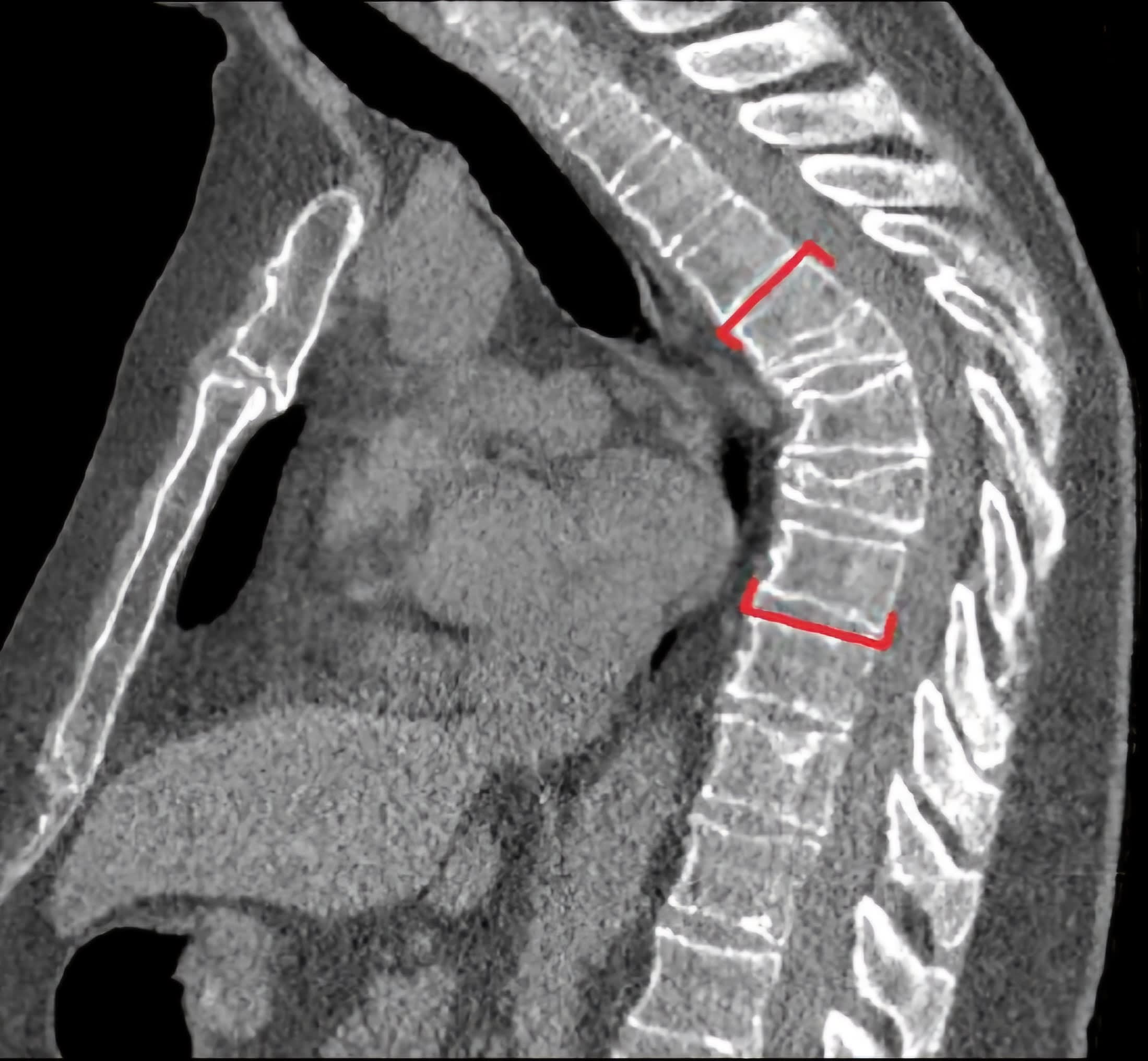 Lateral view, Chest